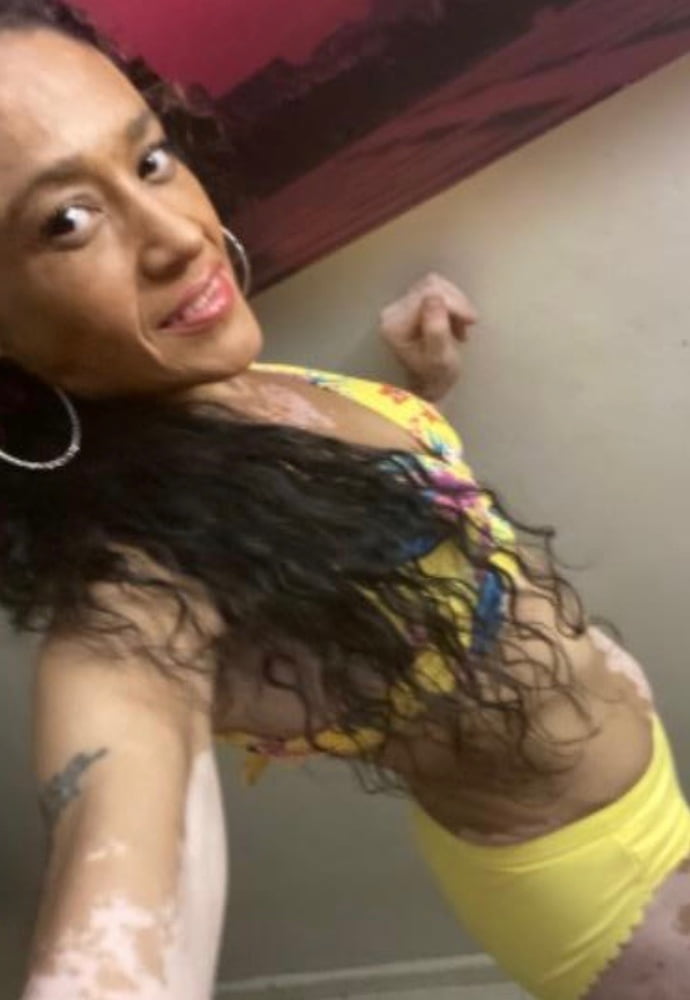 Local Whore - With Vitiligo #99526348