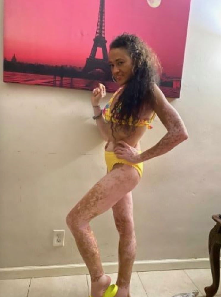 Local Whore - With Vitiligo #99526350