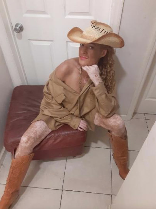 Local Whore - With Vitiligo #99526359