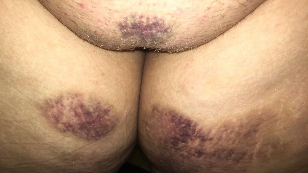 Marks and Bruises #101095197