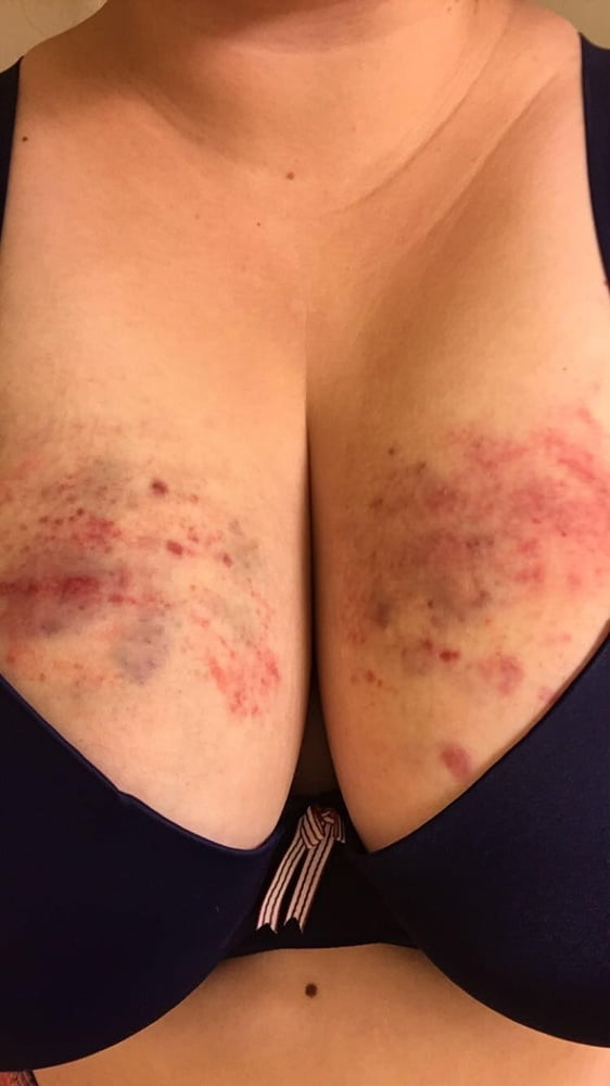 Marks and Bruises #101095199