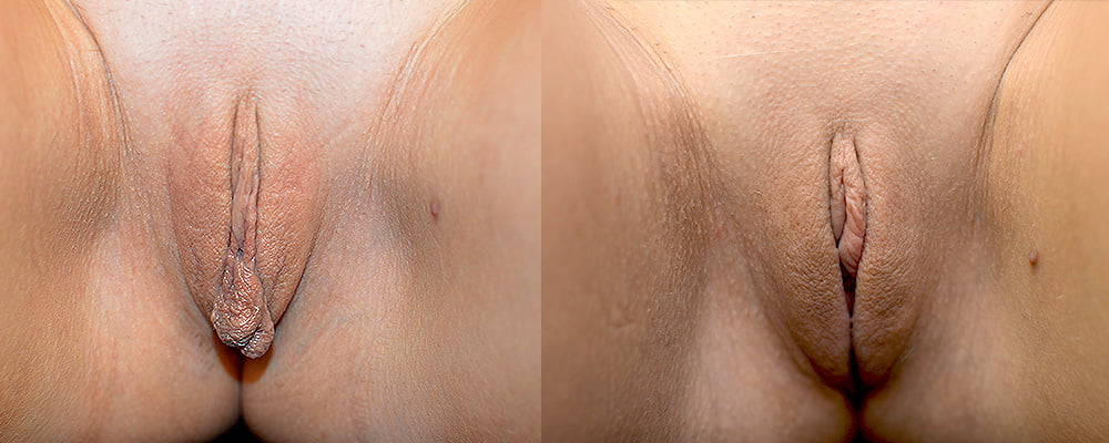 Before and After Labais #81058473