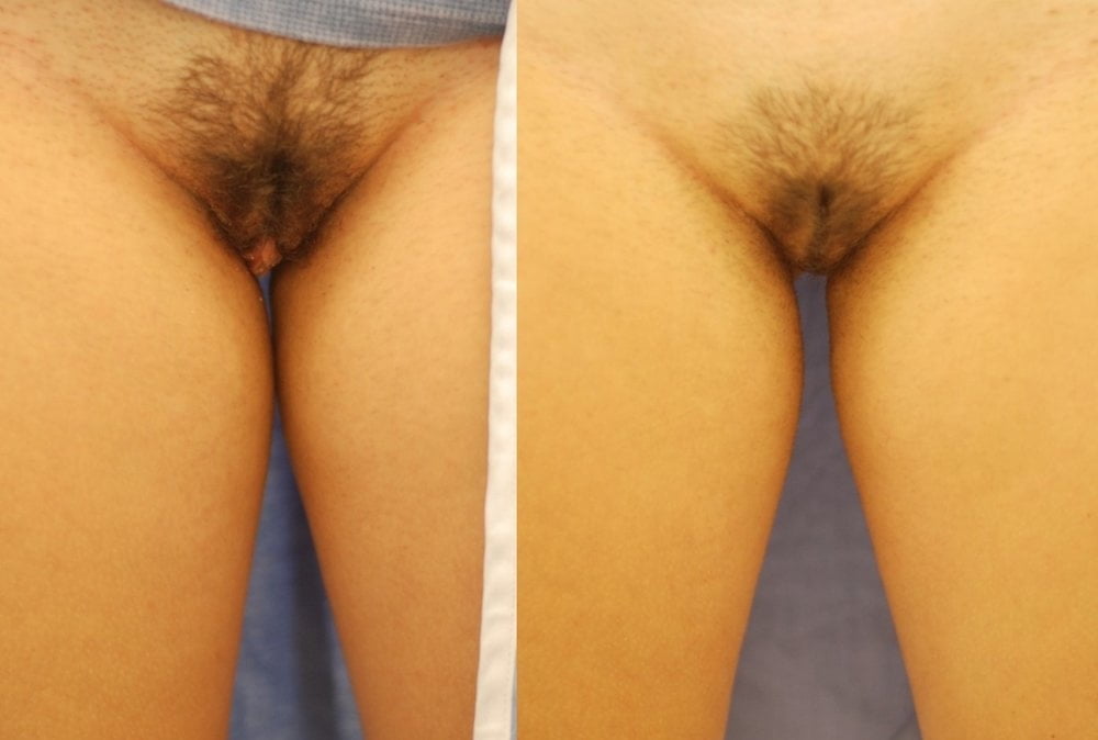 Before and After Labais #81058476