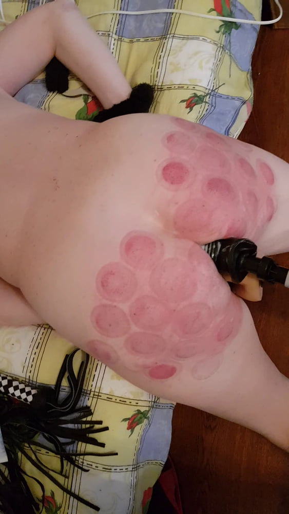 fire cupping for her #93248438