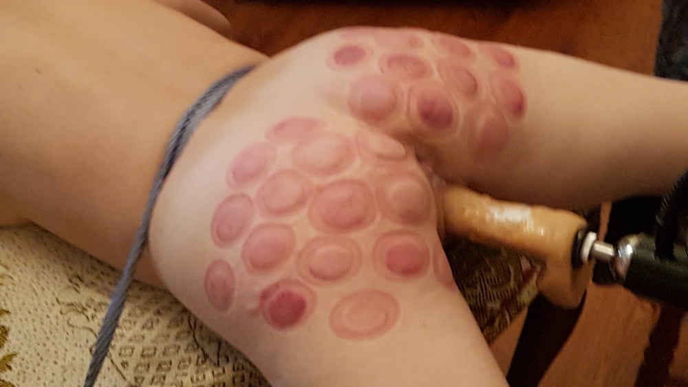 fire cupping for her #93248460
