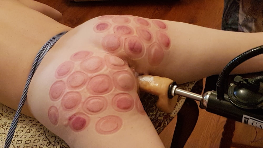 fire cupping for her #93248461
