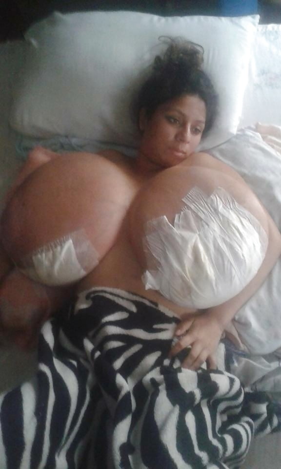 Massive Tits Breast Reduction #98679667