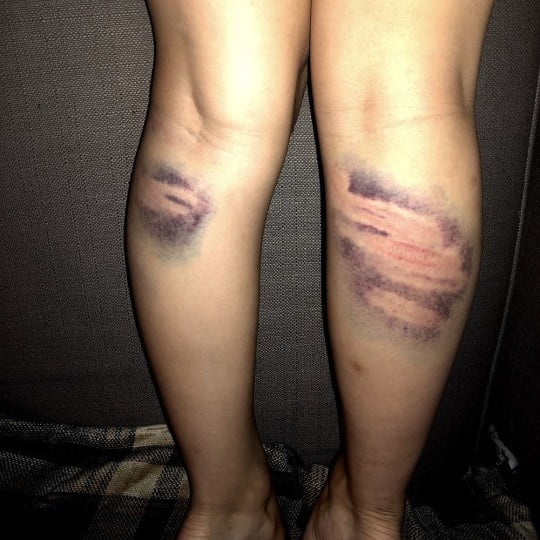 マーキングされた女の子
 #94863785