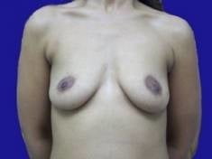 Saggy breast vol 28
 #89607140