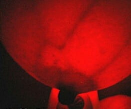 Breast transillumination test #97334956