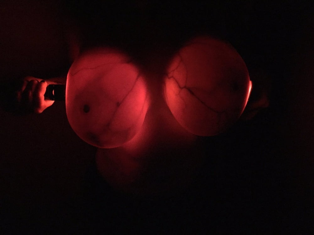 Breast transillumination test #97334965