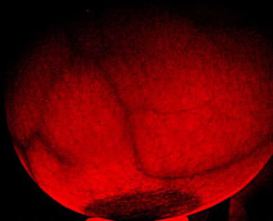 Breast transillumination test #97334970