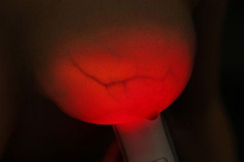 Breast transillumination test #97334971