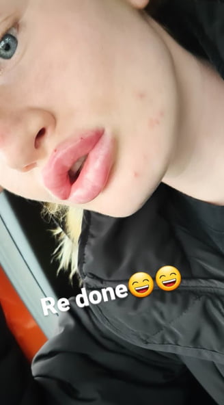 Lips done finaly 3.1mil in em
 #90949152