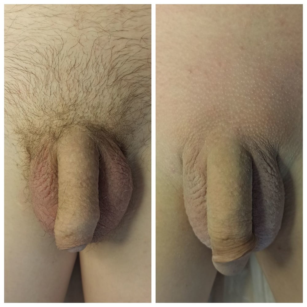 Look! After my procedure, all the dicks really got bigger! #107059181