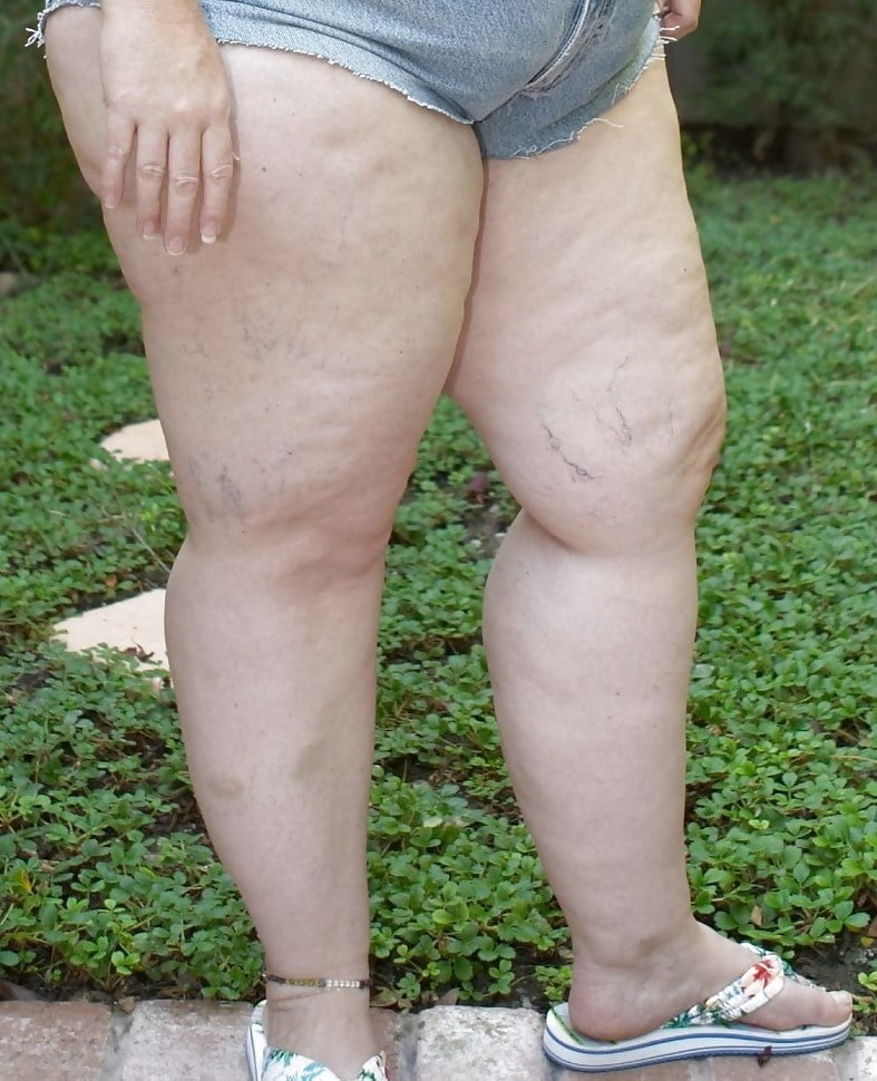 Sexy Cellulite and Stretchmarks #101130093