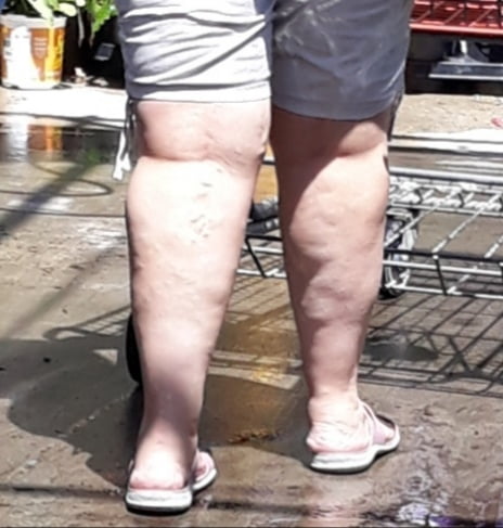 Cellulite Schlampen 2 . sehr fette Arme, schlaffer Arsch, Cellulite Bein
 #87508544