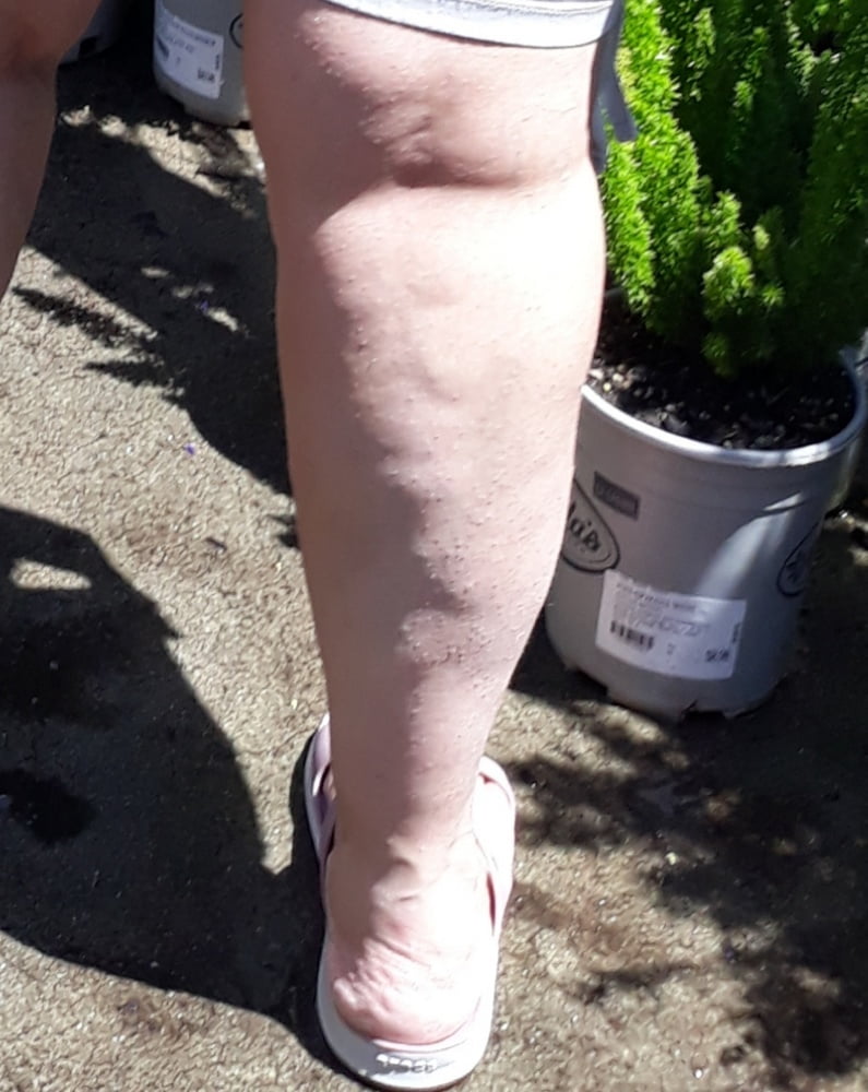 Cellulite Schlampen 2 . sehr fette Arme, schlaffer Arsch, Cellulite Bein
 #87508562