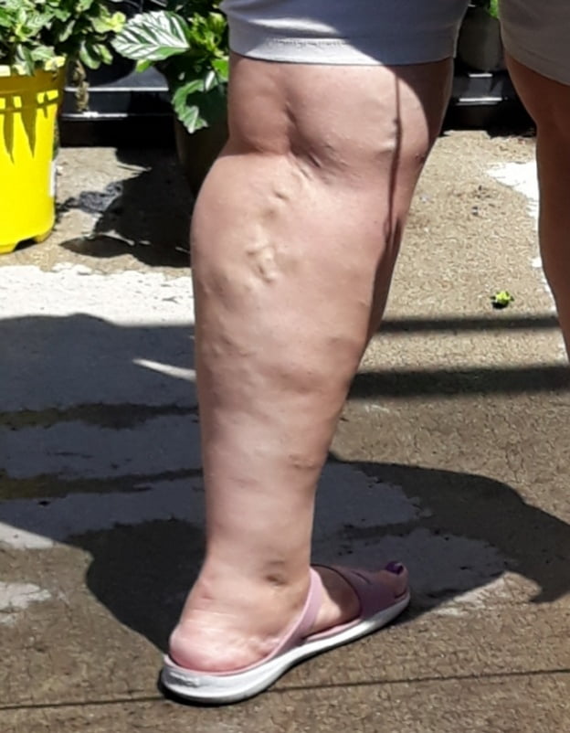 Cellulite Schlampen 2 . sehr fette Arme, schlaffer Arsch, Cellulite Bein
 #87508568