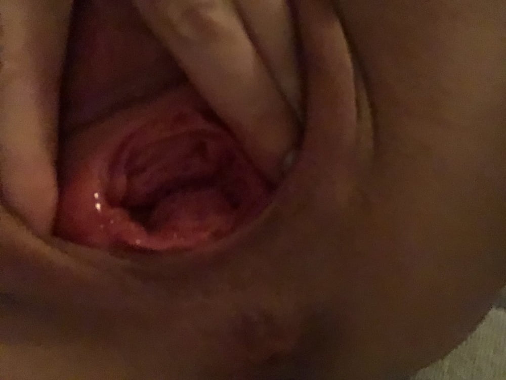 Prolaps Vagina
 #95313750