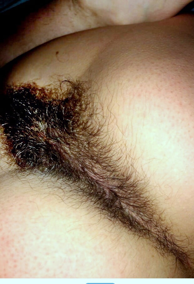 Hirsutism #99576851