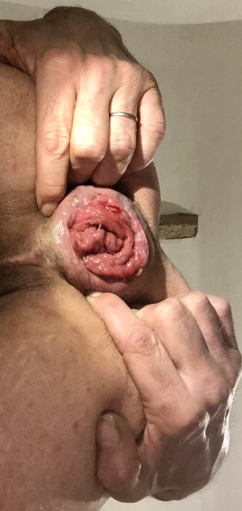 anal Dilation After Big Insertion