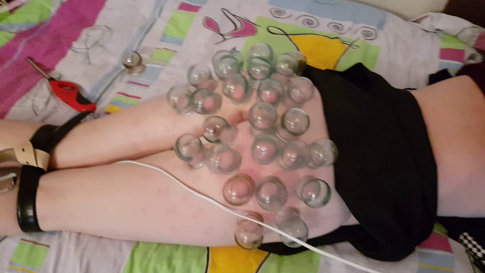 firecupping on buttocks #80067123