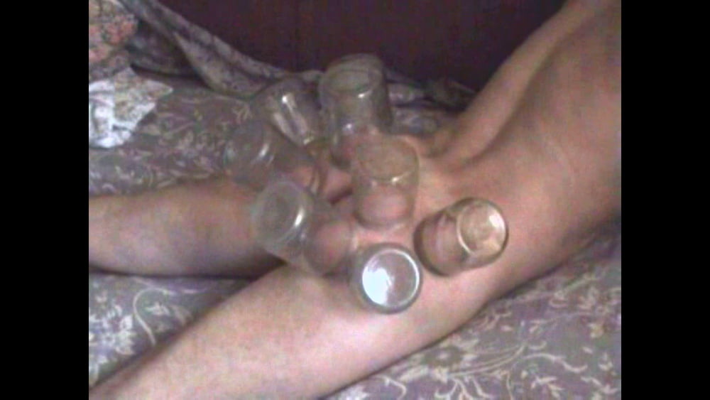 firecupping on buttocks #80067144
